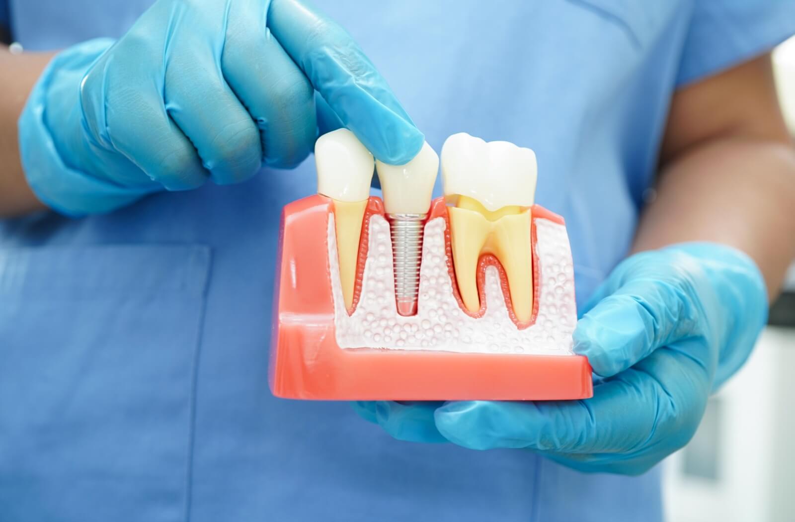 A dentist holds a model of a dental implant, showing how the bone integrates with the metal implant, and how it mimics natural tooth roots.