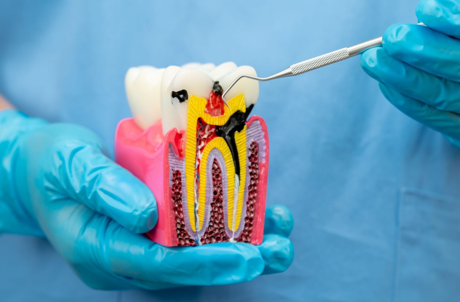 A dentist holds a root canal model in their hand to show the tooth's structure