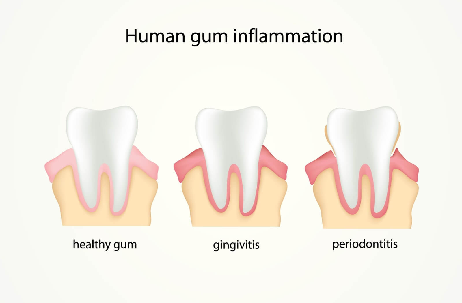 An infographic that outlines the progression of gum disease, from healthy gums to gingivitis and periodontitis.